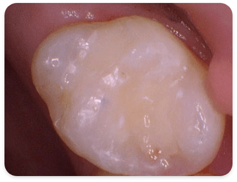 Smile Gallery - Case 1 - After