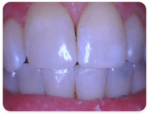 Smile Gallery - Case 2 - After