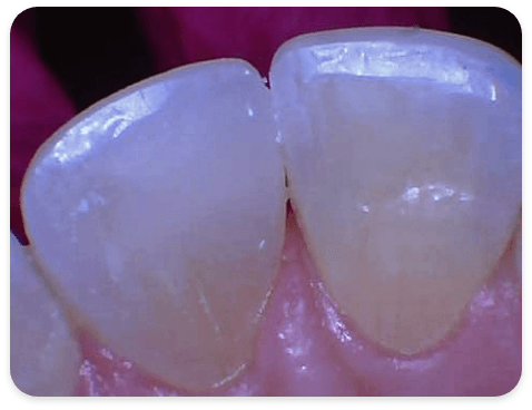 Smile Gallery - Case 4 - After
