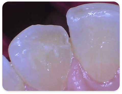 Smile Gallery - Case 4 - Before
