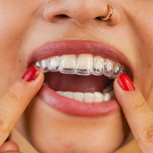 Woman inserting an upper Invisalign tray