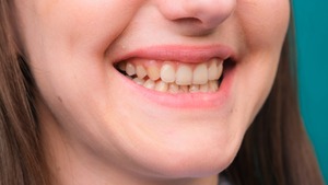 Close-up of smiling woman with yellowed teeth